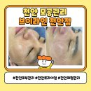 우림필유(아) | 천안 모공관리 후기 남자 피부관리 만족 브이라인 천안점