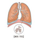 폐결절(Pulmonary nodule) 이미지