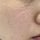 샤인광고 | 구월동 피부과 리쥬란 더마샤인 일주일 비포애프터 후기