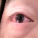 Mydriasis, Loss of Vision, Scarred Cornea and Glaucoma (Photo attached) 이미지