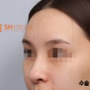 에스에이치의원 | #29 콧볼축소 vs 긴코수술 , 코끝수술은 어떻게 결정해야할까? _ 코끝수술 후기, 코끝수술 회복까지