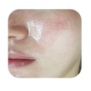 학산한의원 | 포항피부관리 플라즈마 멀티듀얼 이온플라즈마 물광테라피 벨에스테틱