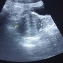 uterus 의 myoma 사진 이미지