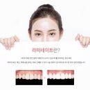 스노우기공소 | 논현역치과 스노우치과 [라미네이트]