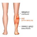 테니스 레그(tennis leg) 이미지