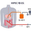 복막암과 복막암 절제술/LHIPEC(복강경 온열 복강 내 고온항암치료) ​ 이미지