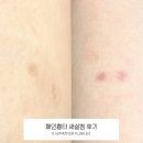 통해의원한의원 | 부산 서면한의원 다리흉터 모기흉터 패인흉터 새살침 후기 및 효능