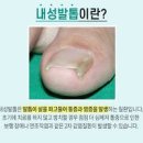 내성발톱 초기 무좀발톱 관리 해결방법 이미지