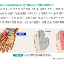 근골격계질환의 종류(수근관증후군=손목터널증후군) 이미지