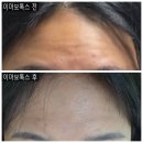 신도시로 | 인천 보톡스 검단신도시 이마 보톡스 일주일 후기