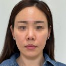 나의계절의원 | 나의계절의원 리프팅필러 (양00고객님 시술후) 사례1후기