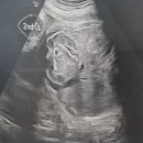 임신일기) 이란성 쌍둥이 32주 2일차, 순천향대 부속 천안병원 산부인과 두 번째 내원 후기