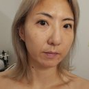 강을보다 | 칙칙하고 탄력없는 피부 의정부 강에스테틱 인오젠 고주파 프락셔널 피부관리 후기