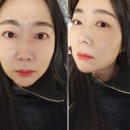 인천 구월동 고주파 볼류머 리프팅 리얼후기