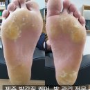 문제성 손발톱 전문관리 케어톱톱