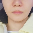 진마디의원 | 닥터스팟여성의원 콜라겐주사 팔자주름 비포애프터 후기