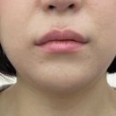미소드림의원 | 리부팅의원 첫 입술필러 자연스러워 만족한 내돈내산 솔직 후기