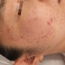 3688 | 광주여드름 압출만 믿다 망한다? 패인 흉터까지 회복된 리셋관리 후기