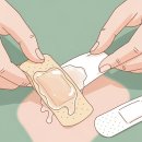 습윤 밴드(메디폼) 교체 시기, 진물이 하얗게 부풀어 오르면 이미지