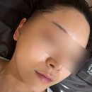 피코 | 강남피부과 피코토닝슈어 내돈내산 후기