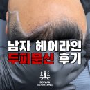 40대 남자 헤어라인 교정, 두피문신으로 티 안 나게 커버한 후기