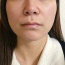 이뻐짐 | 신사역 하이미의원 자연스럽게 이뻐진 입술필러 찐내돈내산후기