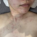 더한의원 | [부산 편평사마귀 제거] 여자 원장님이라 더 안심됐던 대연동 한의원 내돈내산 시술 후기