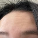 리엔장의원 | 바비톡 보고 다녀온 리엔장 하남미사점 보톡스 후기 | 국산 보톡스 6천원대