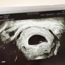 [임신초기] 영뀨부부의 임신일기 1 - 국민행복카드 발급, 난황보기, 심장소리듣기, 오늘 당기는 음식은...