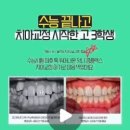한민치과의원 | 대구치아교정치과 치아 잇몸 돌출입 기준 증상 개선 치료