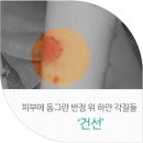 해운대센텀건선 예방과 관리에 대하여