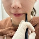 타이탄 | 압구정로데오피부과 온다리프팅 이브타이탄 내돈내산 후기(가격,통증,10일후기)