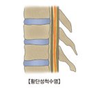 횡단성척수염 (Transvers myelitis) 이미지