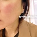 센텀진이비인후과의원 | 부산 해운대 센텀시티 모공 포텐자 후기 효과 솔직 기록 (통증, 붉은기, 변화 과정)