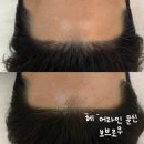 <청주헤어라인> 안 아프면서도 이쁘고 자연스러운 헤어라인 문신 보브로우 방문 솔직 후기