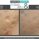 비비테라피 이미지