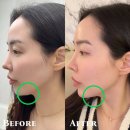 ALL(올)바른 PC | 수원 올타이트리프팅 이중턱 착붙 제거 후기