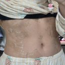 청암한의원 | 신림 후한의원 편평사마귀 제거 1회차 후기