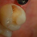 이스타치과의원 | 트리오스5로 더 정확하게! 라바인레이 치료 케이스 - 강남이스타치과(포이사거리,개포동치과)