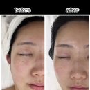 청주 송절동 에스테틱 [유앤데이 에스테틱] 홍조피부관리 비포애프터 후기 (주접ver.)