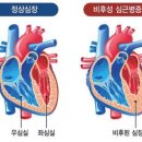 젊은 운동선수에게 심장마비가 나타나는 이유 이미지