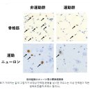 [소식] 케네디병(SBMA)에 운동은 좋은가? 이미지