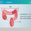 직장암 초기 원인 이미지