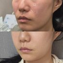 압구정 올리디아 365볼륨, 자갈턱보톡스로 인상부드러워진 후기(병원고르는팁, 통증, 효과)