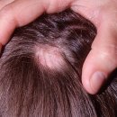 원형탈모 vs 안드로겐 탈모...“증상도, 치료법도 다르다” 이미지