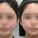 샤프(SHARP)성형외과의원 | 윤곽3종 케이스 분석 | 밋밋한 얼굴형이 이렇게 달라진 이유