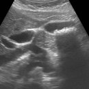 Folded gallbladder, gallstones 이미지