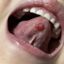 아이입안 혀뒤쪽 염증 이미지