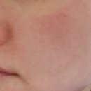 리엔뉴의원 | 포텐자 레이저 모공 치료 3회차 후기입니다.