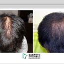 드림헤어라인의원 네이버블로그